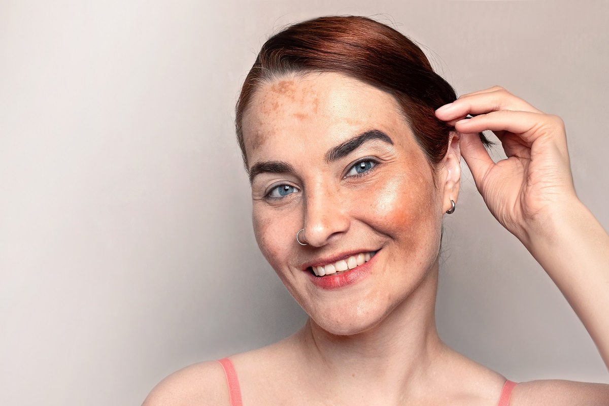 Woman smiles and likes her face with pigmentation, melasma, freckles, age spots photo. Close up photo copy space