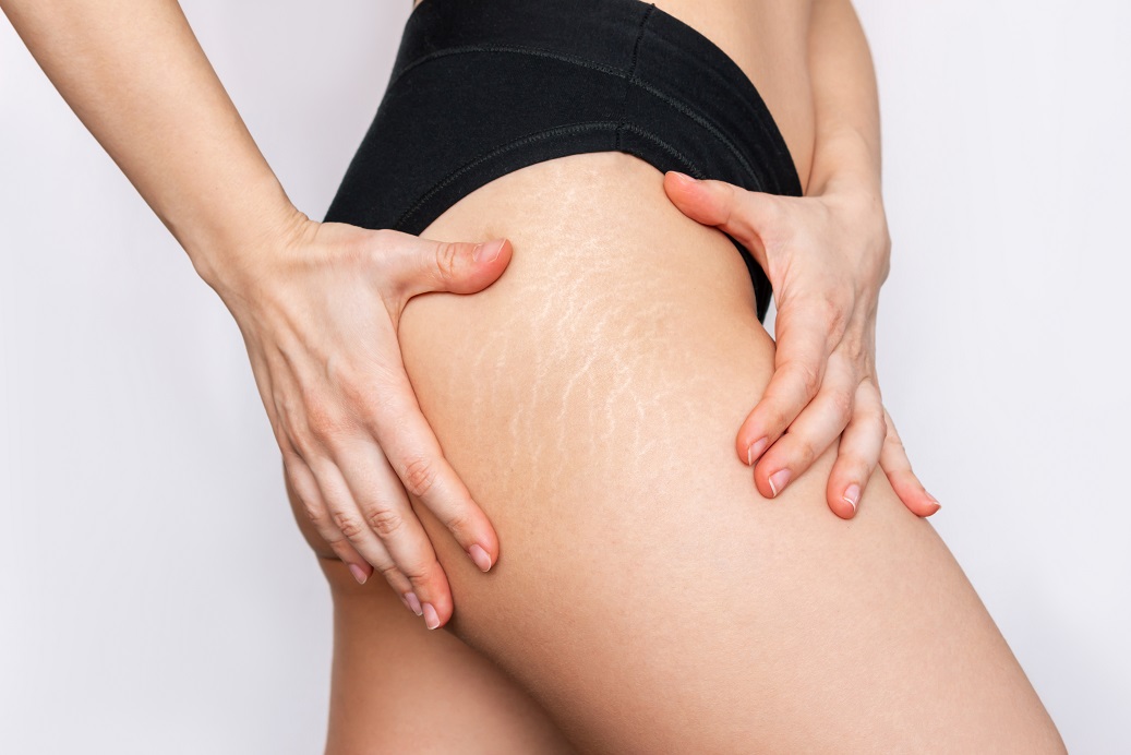 stretch marks